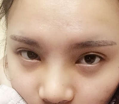 超声波双眼皮,让我尽显美丽980 超声波双眼皮,让我尽显美丽980