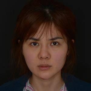 超 声 波去眼袋之后自信感飙升啊 超 声 波去眼袋之后自信感飙升啊
