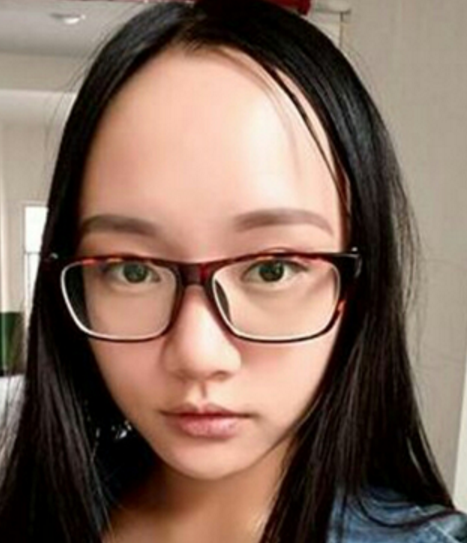 去眼袋手术?wǒ得选择 去眼袋手术?wǒ得选择