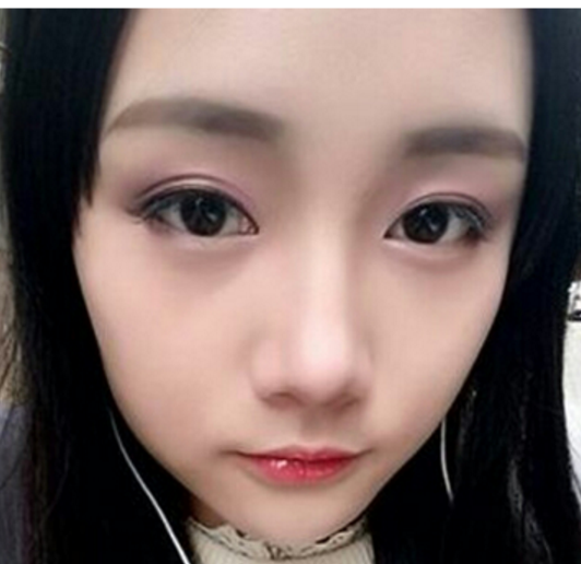 去眼袋手术?wǒ得选择 去眼袋手术?wǒ得选择