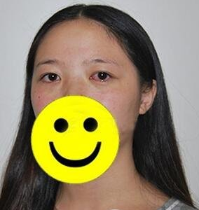 轻松去掉眼袋非超 声 波去眼袋莫属