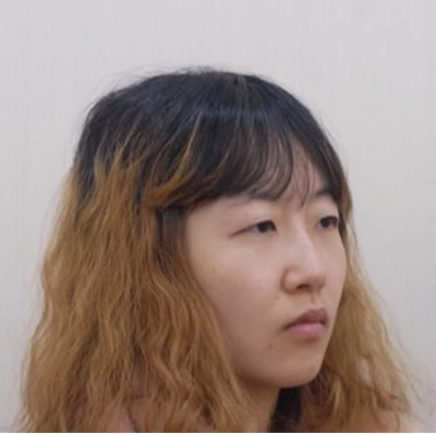 不开刀双眼皮实现了我的双眼皮梦想989 不开刀双眼皮实现了我的双眼皮梦想989