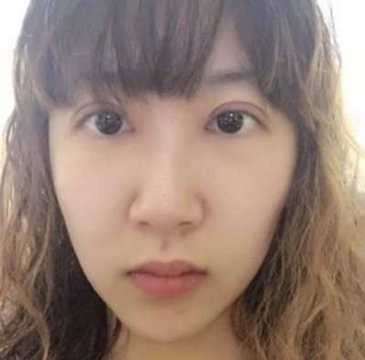 不开刀双眼皮实现了我的双眼皮梦想989 不开刀双眼皮实现了我的双眼皮梦想989
