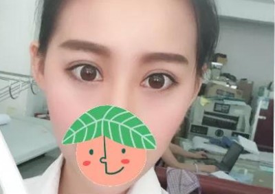 重庆超雅不开刀双眼皮，让我拥有了美轮美奂得双眼皮759