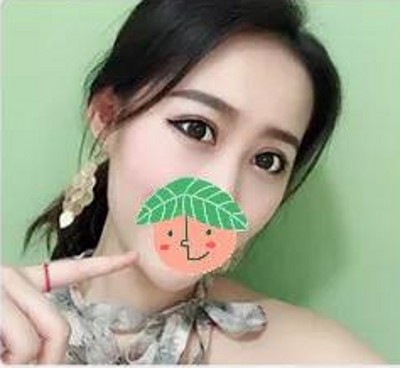 重庆超雅不开刀双眼皮，让我拥有了美轮美奂得双眼皮759