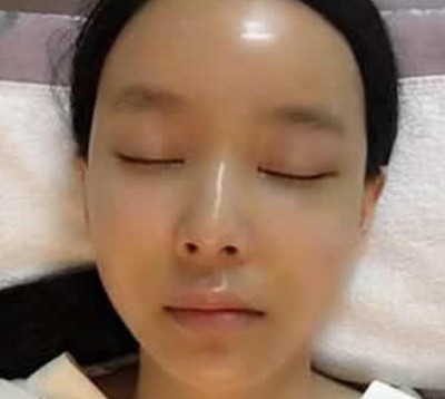 不开刀去眼袋,熬夜我也不怕长眼袋了!978 不开刀去眼袋,熬夜我也不怕长眼袋了!978
