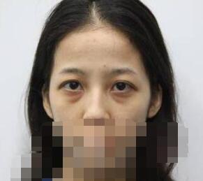 做le超 声 波去眼袋后人变得自信很多le 做le超 声 波去眼袋后人变得自信很多le