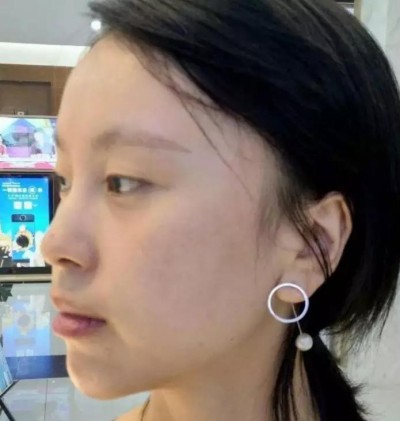 超声波双眼皮让我变得美丽出众566 超声波双眼皮让我变得美丽出众566