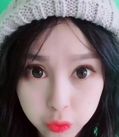 超声波双眼皮让我变得美丽出众566 超声波双眼皮让我变得美丽出众566