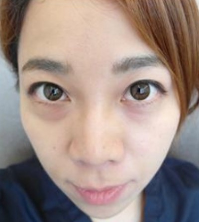 超声波去眼袋让我的眼睛更有神了004 超声波去眼袋让我的眼睛更有神了004