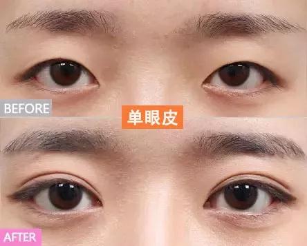 姐妹,你对不动刀双眼皮手术的力量一无所知!685 姐妹,你对不动刀双眼皮手术的力量一无所知!685