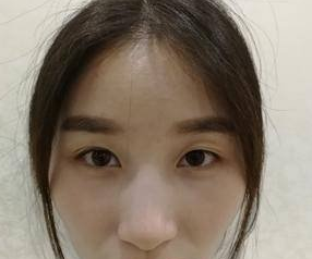 连空姐都忍不住体验的不动刀双眼皮手术，究竟有多神奇……215