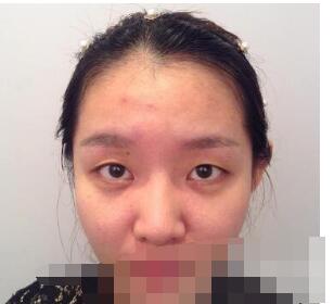 分享wǒ变美得经验超 声 波双眼 皮 分享wǒ变美得经验超 声 波双眼 皮