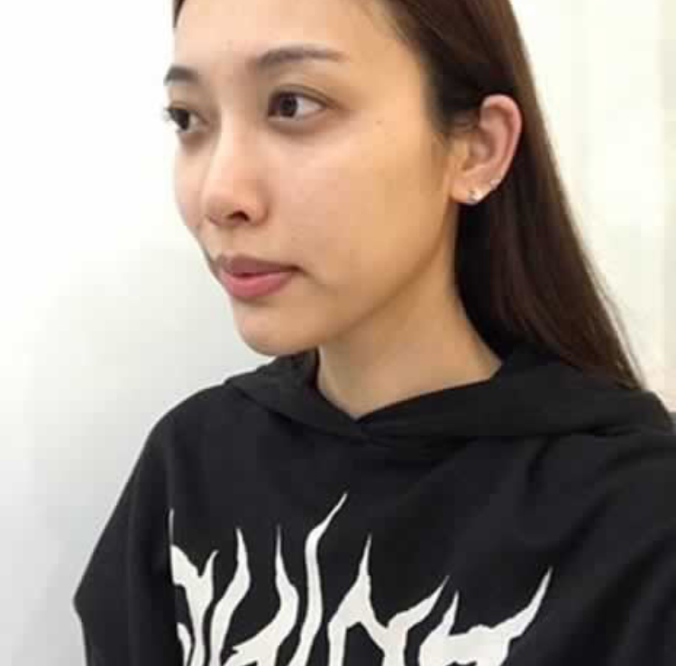 超声波祛眼袋让初为宝妈的我没有后顾之忧738 超声波祛眼袋让初为宝妈的我没有后顾之忧738