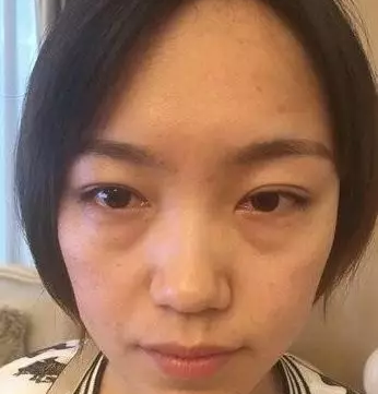 超声波去眼袋让你有的不只是:“面子“!868 超声波去眼袋让你有的不只是:“面子“!868