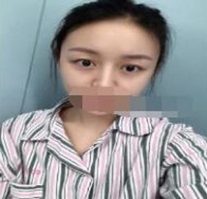 做了超声波双眼皮之后的心得分享747 做了超声波双眼皮之后的心得分享747