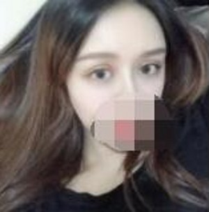做了超声波双眼皮之后的心得分享747 做了超声波双眼皮之后的心得分享747