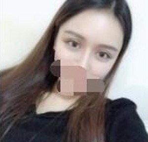 做了超声波双眼皮之后的心得分享747 做了超声波双眼皮之后的心得分享747