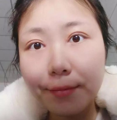 超声波双眼皮人生蜕变第一步!578 超声波双眼皮人生蜕变第一步!578
