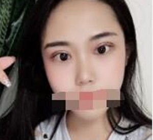 看到我不开刀双眼皮术后变化真的很好823 看到我不开刀双眼皮术后变化真的很好823