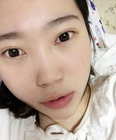 还在为眼袋而烦恼嘛?不妨试试超声波去眼袋034 还在为眼袋而烦恼嘛?不妨试试超声波去眼袋034