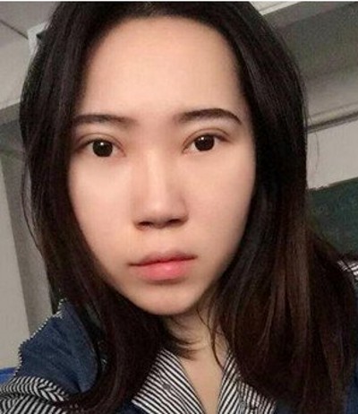 还在为眼袋而烦恼嘛?不妨试试超声波去眼袋034 还在为眼袋而烦恼嘛?不妨试试超声波去眼袋034