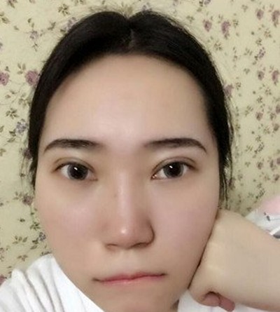 还在为眼袋而烦恼嘛?不妨试试超声波去眼袋034 还在为眼袋而烦恼嘛?不妨试试超声波去眼袋034