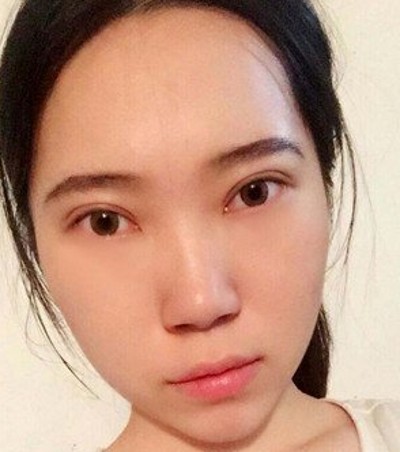 还在为眼袋而烦恼嘛?不妨试试超声波去眼袋034 还在为眼袋而烦恼嘛?不妨试试超声波去眼袋034