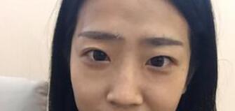 重庆超雅超声波双眼皮案例,分享我的双眼皮~666 重庆超雅超声波双眼皮案例,分享我的双眼皮~666