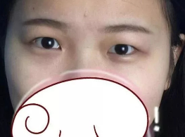 有了双眼皮之后感觉真的很好779 有了双眼皮之后感觉真的很好779