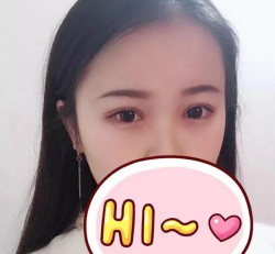 有了双眼皮之后感觉真的很好779 有了双眼皮之后感觉真的很好779