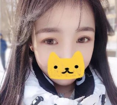 为我蜕变萌妹子历程,超声波双眼皮580 为我蜕变萌妹子历程,超声波双眼皮580