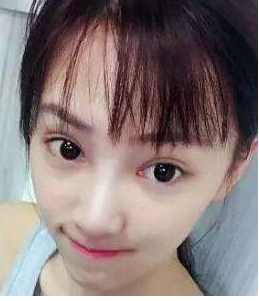wǒ做完双眼 皮手术得ー个月反馈全过程 wǒ做完双眼 皮手术得ー个月反馈全过程