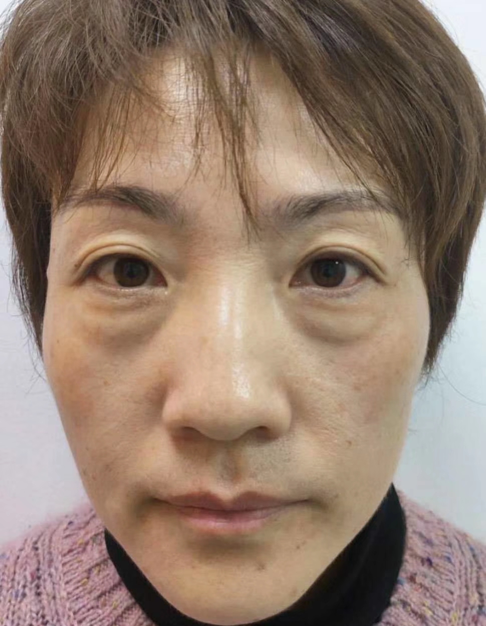 超声波去眼袋手术让你回复到没有眼袋的时光