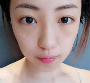 教你“绝招”这样做去眼袋手术,术后不留疤! 教你“绝招”这样做去眼袋手术,术后不留疤!
