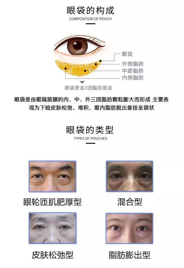 教你“绝招”这样做去眼袋手术,术后不留疤! 教你“绝招”这样做去眼袋手术,术后不留疤!