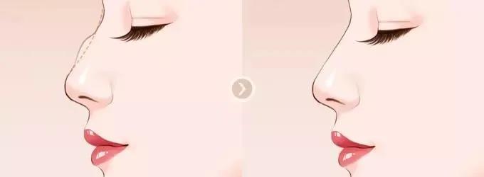 【隆鼻手术】为什么“花木兰”长着驼峰鼻，还能这么好看！？