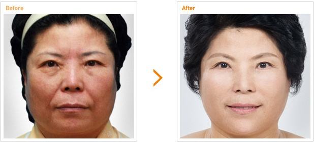 【面部提升术】阿jiao受伤前广告写真曝光！这个颜值状态巅峰啊！