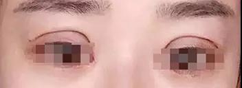【双眼皮手术】这种眼睛来修复，医生会直接拒绝的！！868