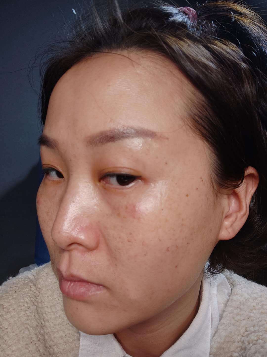 【超皮秒祛斑】秋天第一杯奶茶不重要，重要的是这个...630