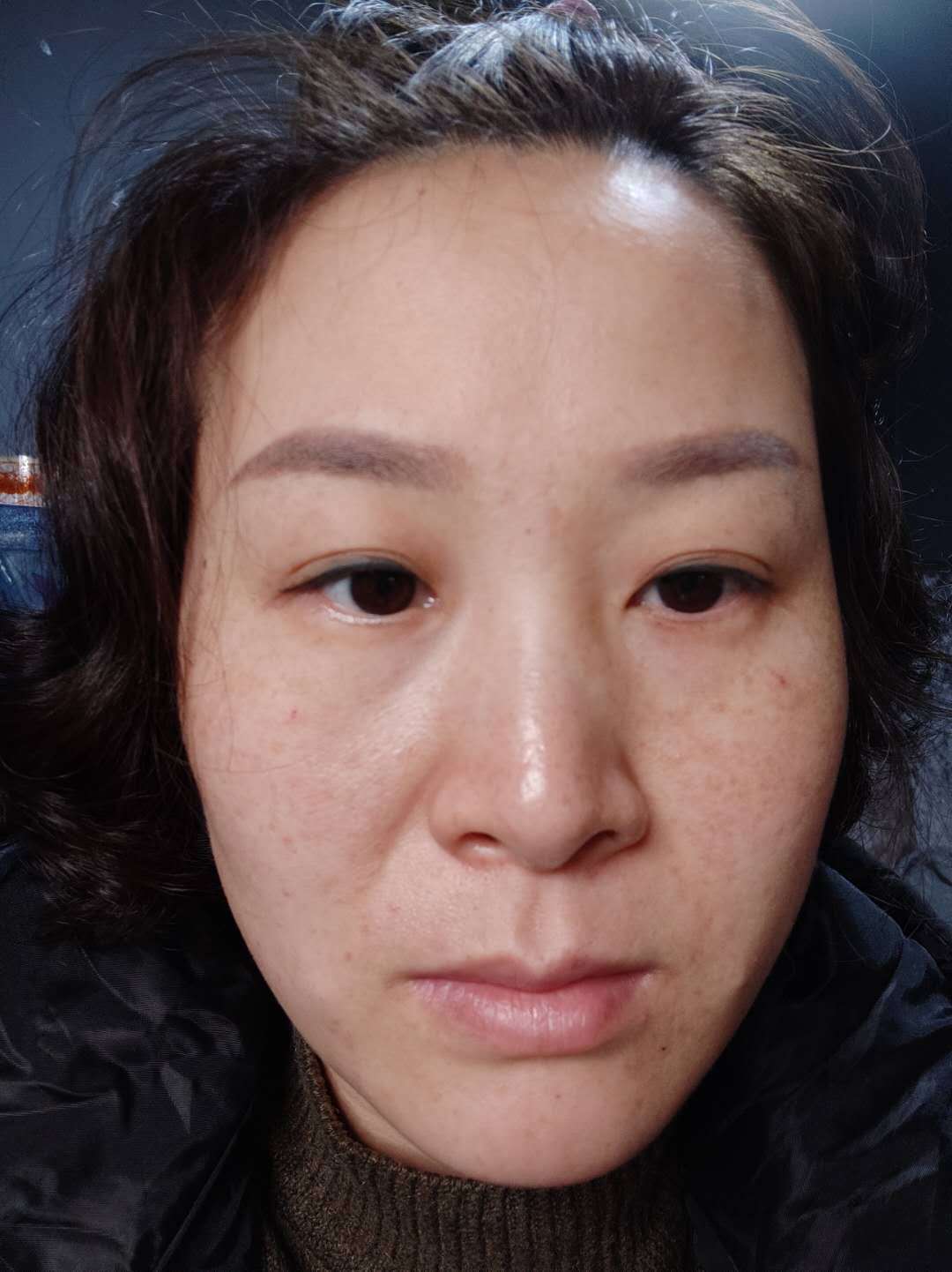 【超皮秒祛斑】秋天第一杯奶茶不重要，重要的是这个...630
