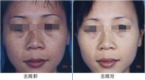 【超皮秒祛斑】人间真实！女生脸上有「斑」会被嫌弃的989