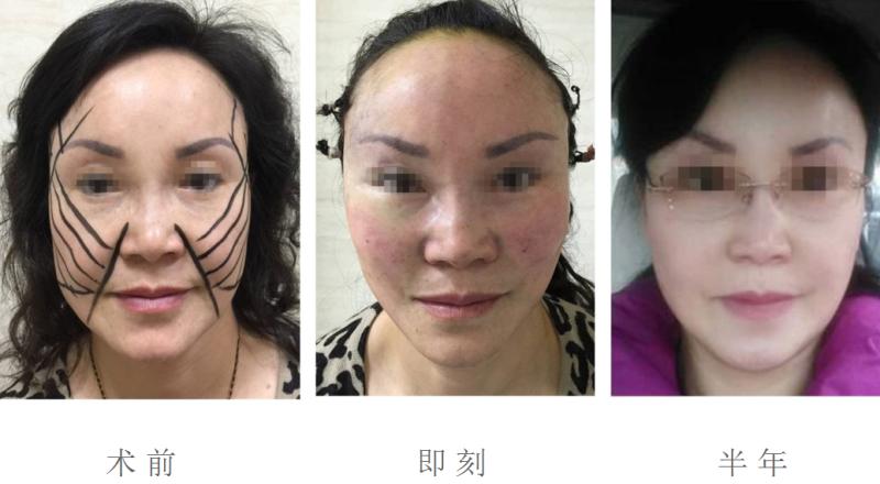 【面部提升术】你所不知道的那些内容~803 【面部提升术】你所不知道的那些内容~803