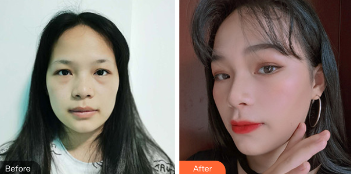 【面部提升术】你所不知道的那些内容~803 【面部提升术】你所不知道的那些内容~803