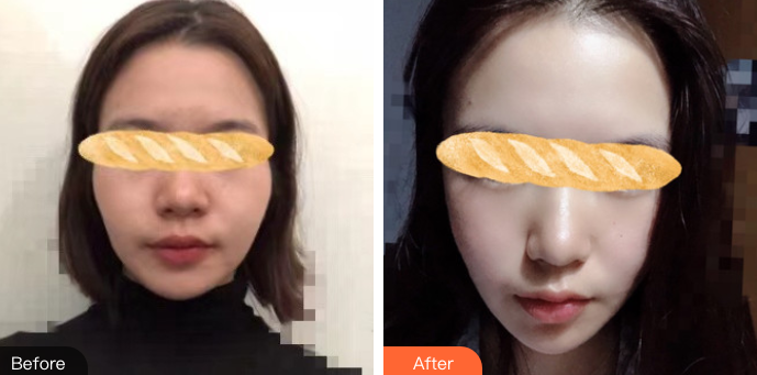 【面部提升术】你所不知道的那些内容~803 【面部提升术】你所不知道的那些内容~803