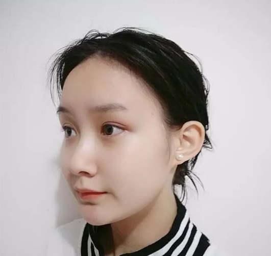 【去眼袋手术】当你已经开电热毯准备入睡时，我却选择了...955