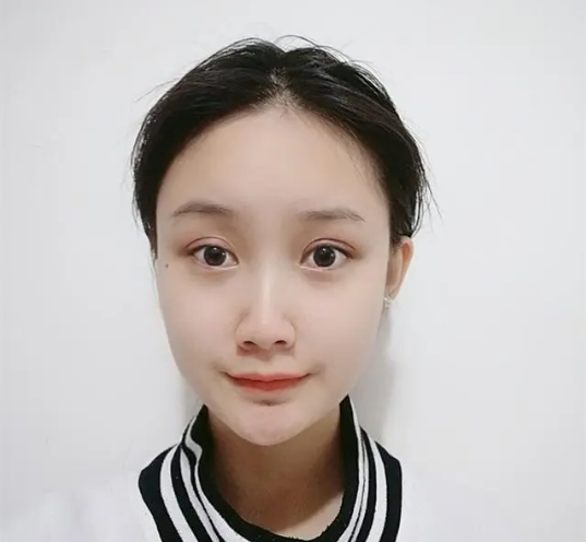 【去眼袋手术】当你已经开电热毯准备入睡时，我却选择了...955