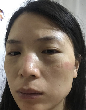 去眼袋手术哪里做最安全?做le手术眼袋会反弹吗? 去眼袋手术哪里做最安全?做le手术眼袋会反弹吗?