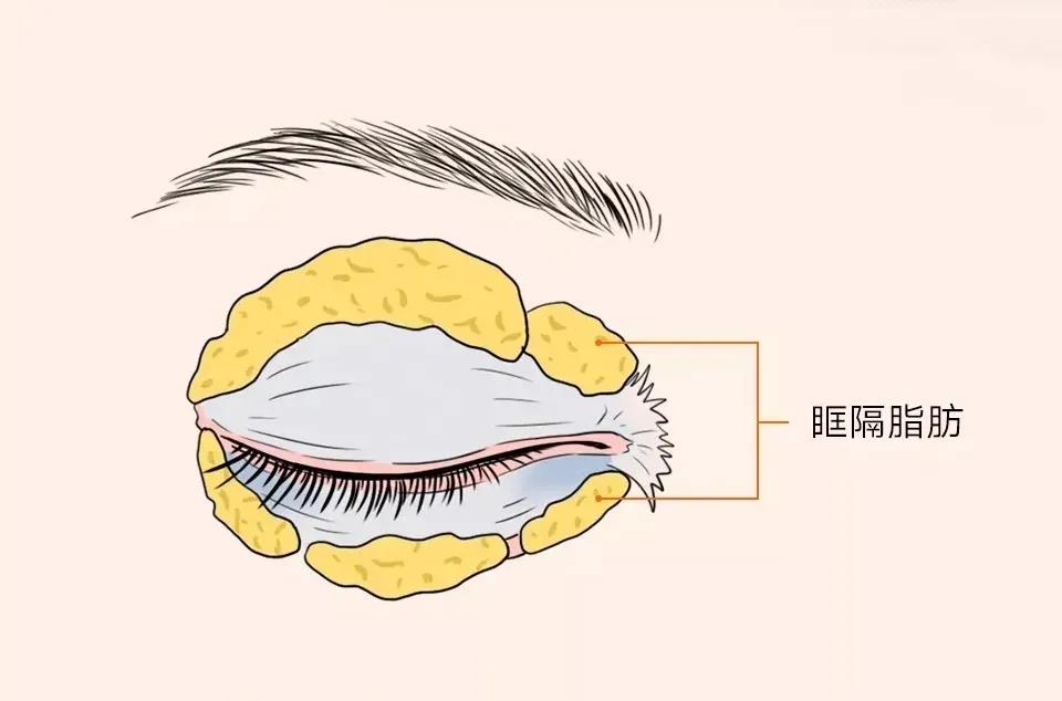 去眼袋手术