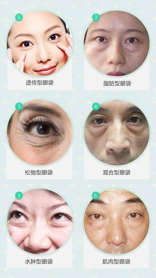 【去眼袋手术】眼袋自测：教你判断自己得眼袋膨出程度！